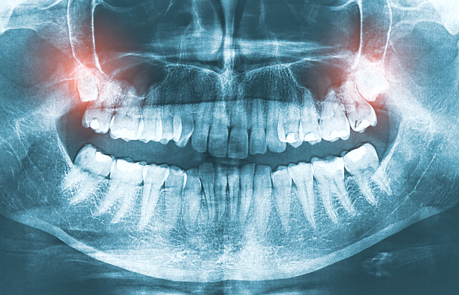 Corrective Jaw Surgery: Restoring Balance and Function for a Better Quality of Life