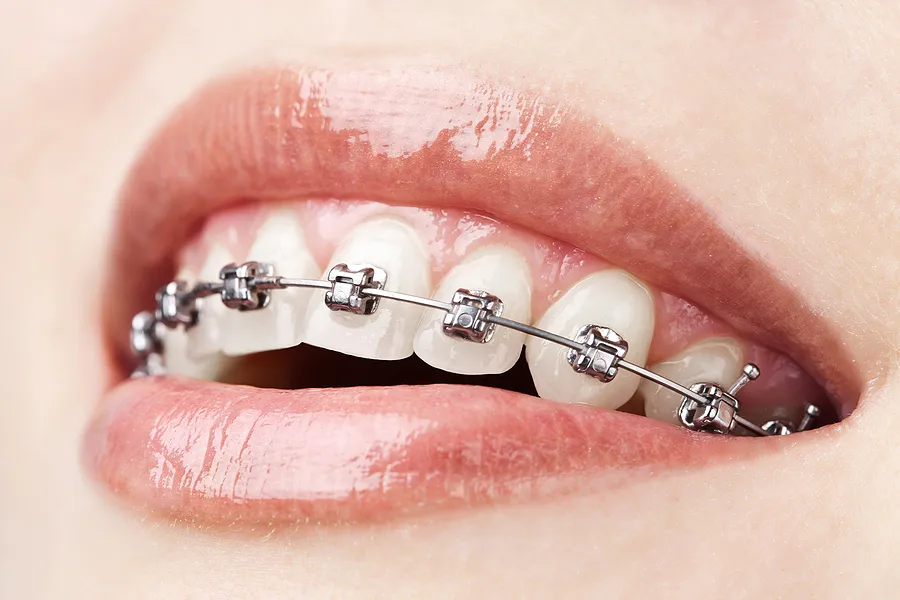 Achieve a Perfect Smile with Braces in Denver, CO