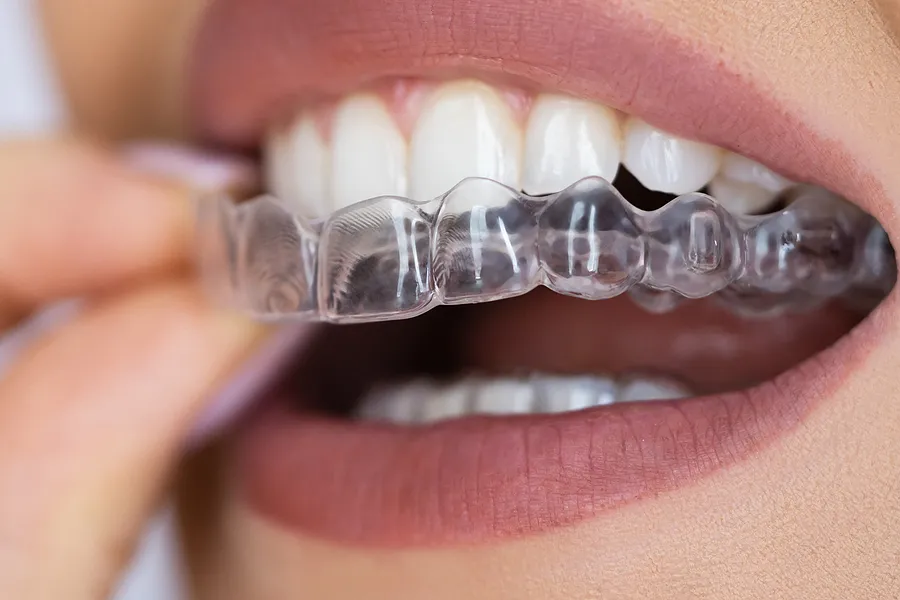Transform Your Smile with Clear Aligners in Denver, CO: A Modern Approach to Orthodontic Care